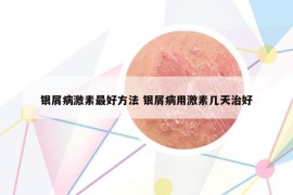 银屑病激素最好方法 银屑病用激素几天治好