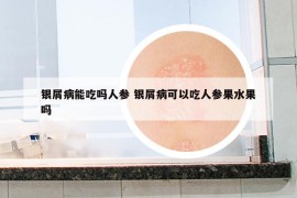 银屑病能吃吗人参 银屑病可以吃人参果水果吗