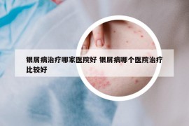 银屑病治疗哪家医院好 银屑病哪个医院治疗比较好