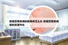 脓疱型银屑病的脓疱疼怎么办 脓疱型银屑病痒的厉害咋办