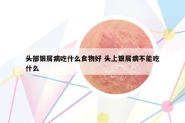 头部银屑病吃什么食物好 头上银屑病不能吃什么