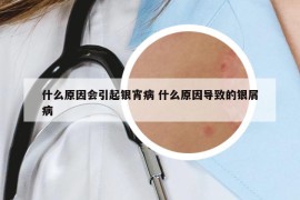 什么原因会引起银宵病 什么原因导致的银屑病