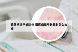 银屑病指甲长脓包 银屑病指甲长脓包怎么治疗