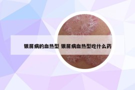 银屑病的血热型 银屑病血热型吃什么药