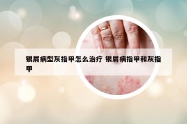 银屑病型灰指甲怎么治疗 银屑病指甲和灰指甲