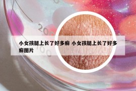 小女孩腿上长了好多癣 小女孩腿上长了好多癣图片