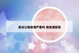 抓会让银屑病严重吗 银屑病抓挠