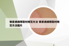 银屑病病理取材规范方法 银屑病病理取材规范方法图片