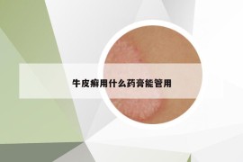 牛皮癣用什么药膏能管用