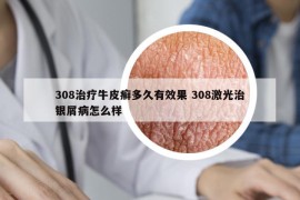 308治疗牛皮癣多久有效果 308激光治银屑病怎么样