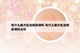 有什么偏方能治银屑病吗 有什么偏方能治银屑病吗女性