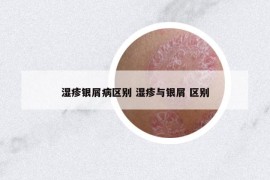 湿疹银屑病区别 湿疹与银屑 区别