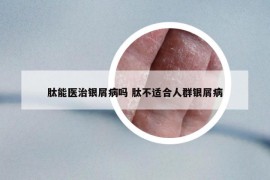 肽能医治银屑病吗 肽不适合人群银屑病