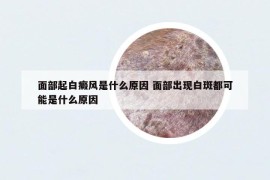 面部起白癜风是什么原因 面部出现白斑都可能是什么原因