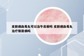 皮肤病血毒丸可以治牛皮癣吗 皮肤病血毒丸治疗银屑病吗