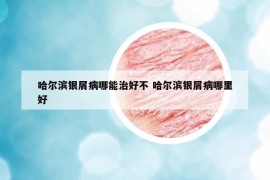 哈尔滨银屑病哪能治好不 哈尔滨银屑病哪里好