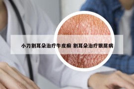 小刀割耳朵治疗牛皮癣 割耳朵治疗银屑病