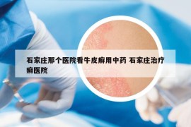 石家庄那个医院看牛皮癣用中药 石家庄治疗癣医院