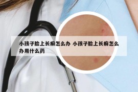 小孩子脸上长癣怎么办 小孩子脸上长癣怎么办用什么药