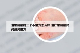 治银屑病的三个小偏方怎么样 治疗银屑病民间最灵偏方