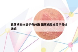 银屑病能吃筒子骨炖汤 银屑病能吃筒子骨炖汤嘛