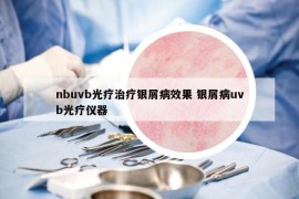 nbuvb光疗治疗银屑病效果 银屑病uvb光疗仪器