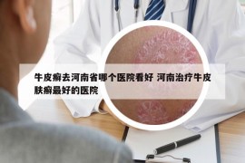 牛皮癣去河南省哪个医院看好 河南治疗牛皮肤癣最好的医院