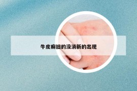 牛皮癣旧的没消新的出现