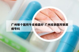 广州哪个医院牛皮癣最好 广州皮肤医院银屑病专科