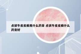 点状牛皮皮癣用什么药膏 点状牛皮皮癣什么药膏好