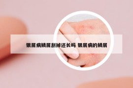 银屑病鳞屑刮掉还长吗 银屑病的鳞屑