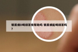 银屑病D喝绿茶有帮助吗 银屑病能喝绿茶吗?