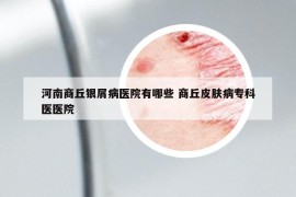 河南商丘银屑病医院有哪些 商丘皮肤病专科医医院