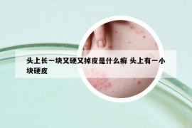 头上长一块又硬又掉皮是什么癣 头上有一小块硬皮