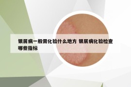 银屑病一般需化验什么地方 银屑病化验检查哪些指标