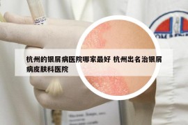 杭州的银屑病医院哪家最好 杭州出名治银屑病皮肤科医院