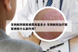 生物制剂银屑病费用是多少 生物制剂治疗银屑病有什么副作用?