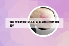 银屑病生物制剂怎么购买 银屑病生物制剂哪里有