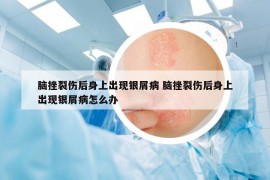 脑挫裂伤后身上出现银屑病 脑挫裂伤后身上出现银屑病怎么办