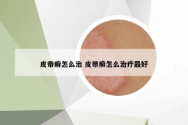 皮带癣怎么治 皮带癣怎么治疗最好