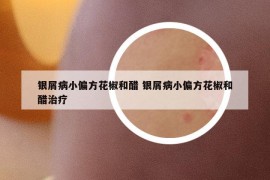 银屑病小偏方花椒和醋 银屑病小偏方花椒和醋治疗