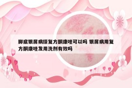 脚底银屑病搽复方酮康唑可以吗 银屑病用复方酮康唑发用洗剂有效吗