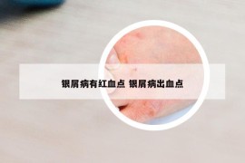 银屑病有红血点 银屑病出血点