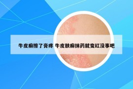 牛皮癣擦了膏疼 牛皮肤癣抹药就变红没事吧