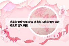 泛发型疱疹性银屑病 泛发型脓疱型银屑病最常见的诱发原因