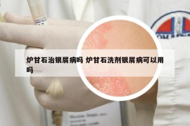 炉甘石治银屑病吗 炉甘石洗剂银屑病可以用吗