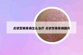 点状型银屑病怎么治疗 点状性银屑病图片