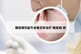 糖尿病引起牛皮癣怎样治疗 糖尿病 癣