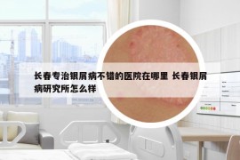 长春专治银屑病不错的医院在哪里 长春银屑病研究所怎么样