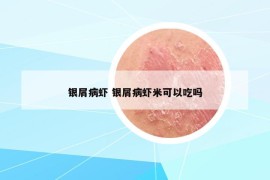 银屑病虾 银屑病虾米可以吃吗